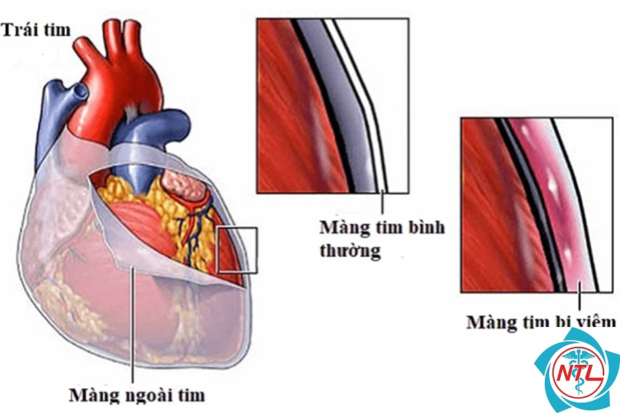 viêm màng ngoài tim do suy thận - Image 4
