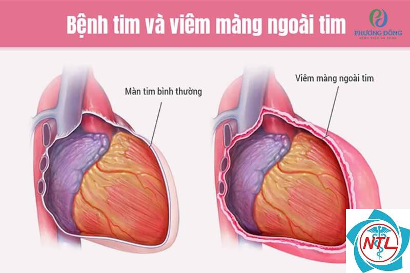viêm màng ngoài tim do suy thận - Image 5