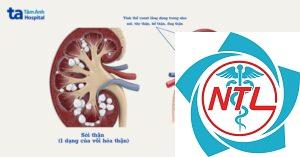 vôi hóa mô mềm do suy thận