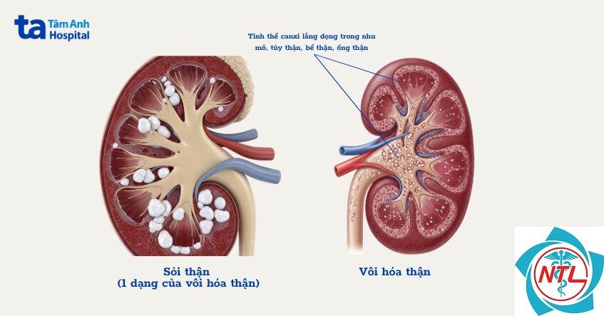 vôi hóa mô mềm do suy thận